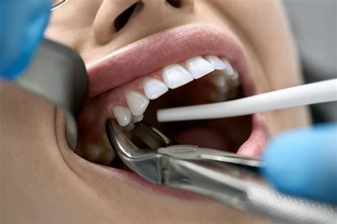 extração de dente